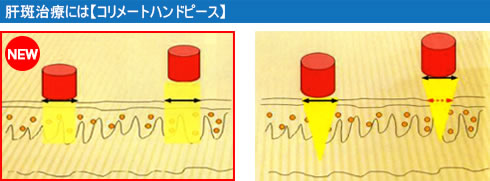 肝斑治療には【コリメートハンドピース】
